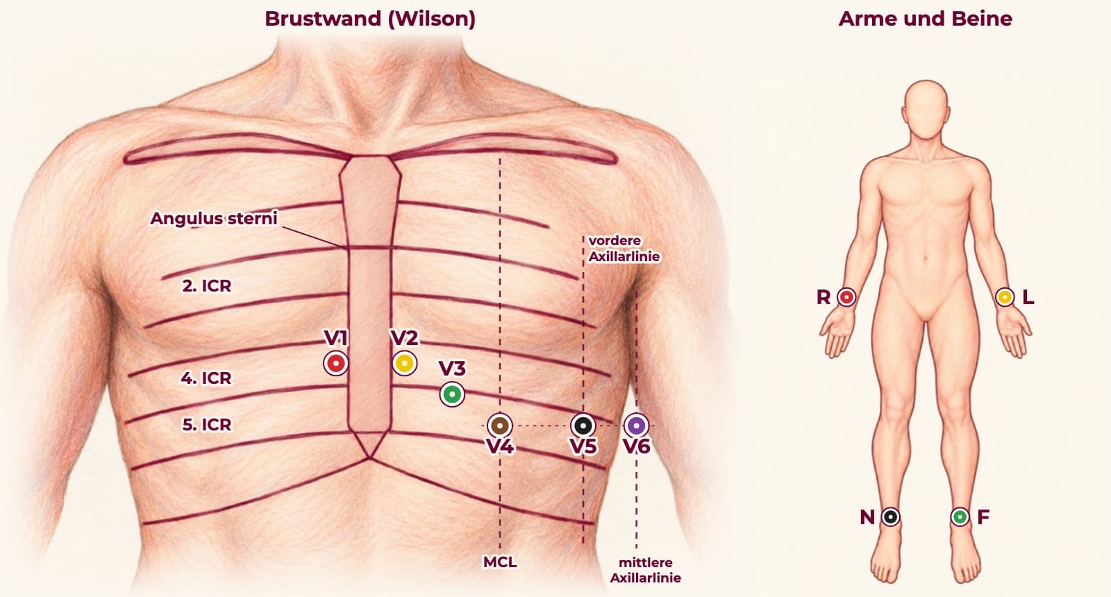 Gezeichnete Elektrodenpositionen beim 12-Kanal-EKG, Ansicht von vorn: V1 und V2 im 4. Interkostalraum rechts und links am Brustbein, V3 dazwischen, V4 im 5. Interkostalraum auf der Medioklavikularlinie, V5 und V6 auf gleicher Höhe an vorderer und mittlerer Axillarlinie. Daneben die vier Extremitätenelektroden: R rechter Unterarm, L linker Unterarm, F linkes Bein, N rechtes Bein.